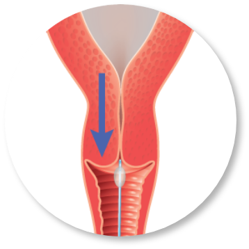 FemVue for Infertility Testing Step 4